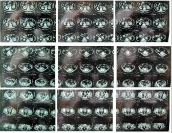 醫(yī)患同心抗病魔，多科合作顯神威 ——泌尿外科成功實施一例老年女性左側(cè)泌尿系及膀胱根治性切除手術(shù)